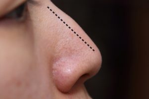 nose with surgery line with nose surgery